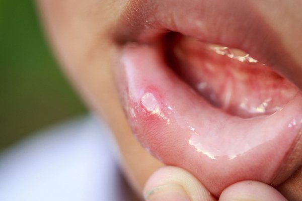 Img post Aftas dentales: las incómodas llagas de la boca. Causas, tratamiento y consejos de prevención